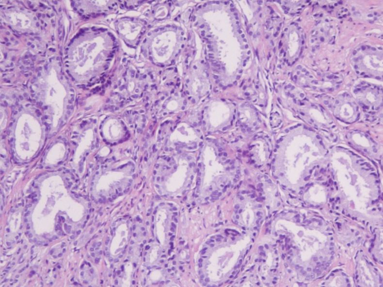 Τομή καρκίνου του προστάτη μετά από χρώση Hematohylin – Eosin
